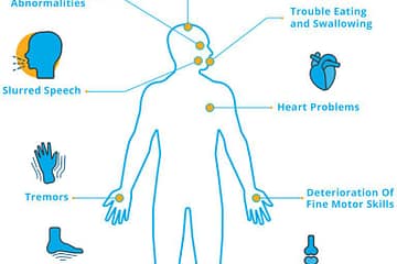 What is ataxia? National Ataxia Foundation